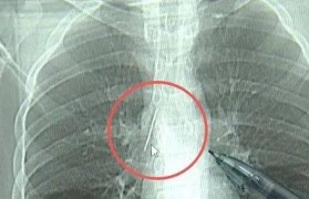 17岁小伙参军体检发现胸腔内有根5cm缝衣针，父母回忆或是1岁时扎入，取出时已锈迹斑斑
